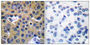 Immunohistochemical analysis of paraffin-embedded human breast carcinoma using Anti-SHP-2 (phospho Tyr542) Antibody. The right hand panel represents a negative control, where the Antibody was pre-incubated with the immunising peptide