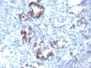 Immunohistochemical analysis of formalin-fixed, paraffin-embedded human colon carcinoma using Anti-Transgelin Antibody [SPM606]