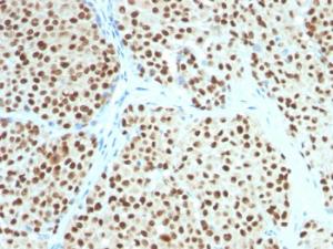 Immunohistochemical analysis of formalin-fixed, paraffin-embedded human melanoma using Anti-SOX10 Antibody [SOX10/991]