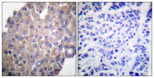 Immunohistochemical analysis of paraffin-embedded human breast carcinoma using Anti-PLCG1 (phospho Tyr771) Antibody. The right hand panel represents a negative control, where the antibody was pre-incubated with the immunising peptide