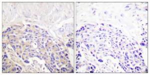 Immunohistochemical analysis of paraffin-embedded human breast cancer using Anti-PLCG1 (phospho Tyr771) Antibody 1:100 (4°C overnight). The right hand panel represents a negative control, where the antibody was pre-incubated with the immunising peptide