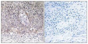 Immunohistochemical analysis of paraffin-embedded human cervix carcinoma tissue using Anti-ARSA Antibody. The right hand panel represents a negative control, where the antibody was pre-incubated with the immunising peptide.