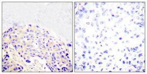 Immunohistochemical analysis of paraffin-embedded human breast cancer using Anti-PLCG1 (phospho Tyr771) Antibody 1:100 (4°C overnight). The right hand panel represents a negative control, where the antibody was pre-incubated with the immunising peptide