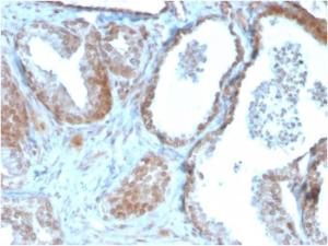 Immunohistochemical analysis of formalin-fixed, paraffin-embedded human prostate carcinoma using Anti-TIGIT Antibody [TIGIT/3106]