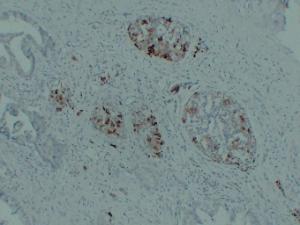 Immunohistochemical analysis of paraffin-embedded human Pancreatic carcinoma using Anti-IGF 2 Antibody