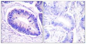 Immunohistochemical analysis of paraffin-embedded human colon carcinoma using Anti-MYPT1 (phospho Thr853) Antibody. The right hand panel represents a negative control, where the Antibody was pre-incubated with the immunising peptide