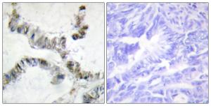 Immunohistochemical analysis of paraffin-embedded human colon carcinoma using Anti-SMF Antibody. The right hand panel represents a negative control, where the antibody was pre-incubated with the immunising peptide