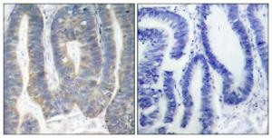 Immunohistochemical analysis of paraffin-embedded human colon carcinoma using Anti-PKR Antibody. The right hand panel represents a negative control, where the antibody was pre-incubated with the immunising peptide