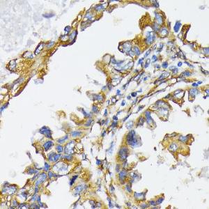 Immunohistochemistry analysis of paraffin-embedded human lung cancer using Anti-GRP94 Antibody (A12747) at a dilution of 1:200 (40x lens). Perform microwave antigen retrieval with 10 mM PBS buffer pH 7.2 before commencing with IHC staining protocol.