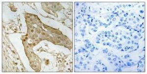 Immunohistochemical analysis of paraffin-embedded human breast cancer using Anti-p53 Antibody 1:100 (4 °C overnight). The right hand panel represents a negative control, where the antibody was pre-incubated with the immunising peptide