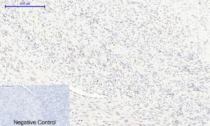 Immunohistochemical analysis of paraffin-embedded human uterus cancer tissue using Anti-mTOR (phospho Ser2448) Antibody at 1:200 (4°C overnight). Negative control was secondary antibody only.