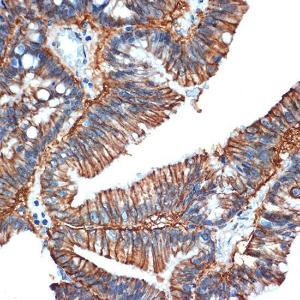 Immunohistochemistry analysis of paraffin-embedded human colon carcinoma tissue using Anti-GPA33 Antibody [ARC2060] (A308311) at a dilution of 1:100 (40x lens)