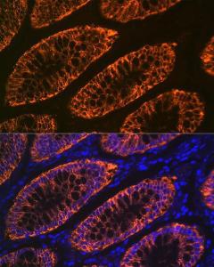 Immunofluorescence analysis of human colon carcinoma using Anti-GPA33 Antibody [ARC2060] (A308311) at a dilution of 1:100 (40x lens). DAPI was used to stain the cell nuclei (blue)