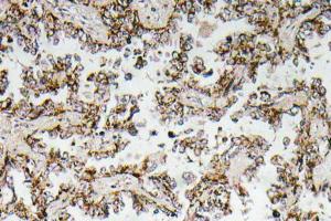 Immunohistochemical analysis of paraffin-embedded human lung carcinoma tissue using Anti-CRF Antibody