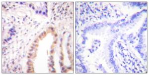 Immunohistochemical analysis of paraffin-embedded human lung carcinoma using Anti-MEF2D (phospho Ser444) Antibody The right hand panel represents a negative control, where the antibody was pre-incubated with the immunising peptide