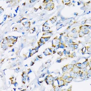 Immunohistochemistry analysis of paraffin-embedded human breast cancer tissue using Anti-Hexokinase II Antibody (A12752) at a dilution of 1:200 (40x lens). Perform microwave antigen retrieval with 10 mM PBS buffer pH 7.2 before commencing with IHC staining protocol.