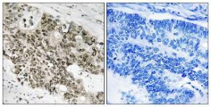 Immunohistochemical analysis of paraffin-embedded human colon carcinoma using Anti-ATR Antibody. The right hand panel represents a negative control, where the antibody was pre-incubated with the immunising peptide.