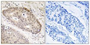 Immunohistochemical analysis of paraffin-embedded human lung carcinoma tissue using Anti-ALS2CR8 Antibody. The right hand panel represents a negative control, where the antibody was pre-incubated with the immunising peptide