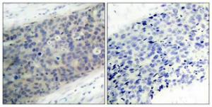 Immunohistochemical analysis of paraffin-embedded human breast carcinoma using Anti-LIMK2 (phospho Thr505) Antibody. The right hand panel represents a negative control, where the antibody was pre-incubated with the immunising peptide