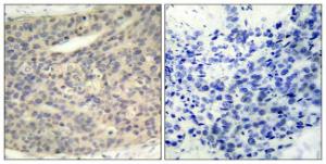 Immunohistochemical analysis of paraffin-embedded human breast carcinoma using Anti-LIMK1 (phospho Thr508) Antibody. The right hand panel represents a negative control, where the antibody was pre-incubated with the immunising peptide