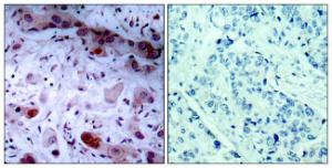 Immunohistochemical analysis of paraffin-embedded human breast carcinoma using Anti-JAK1 (phospho Tyr1022) Antibody. The right hand panel represents a negative control, where the Antibody was pre-incubated with the immunising peptide