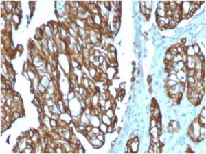 Immunohistochemical analysis of formalin-fixed, paraffin-embedded human colon carcinoma using Anti-TROP2 Antibody [TACSTD2/2151]