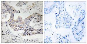 Immunohistochemical analysis of paraffin-embedded human breast carcinoma tissue using Anti-ALDH3B1 Antibody. The right hand panel represents a negative control, where the antibody was pre-incubated with the immunising peptide.