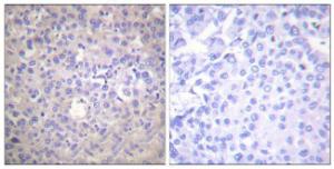 Immunohistochemical analysis of paraffin-embedded human breast carcinoma using Anti-IRS-1 (phospho Ser612) Antibody. The right hand panel represents a negative control, where the antibody was pre-incubated with the immunising peptide