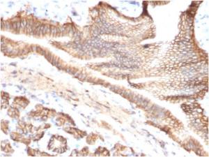 Immunohistochemical analysis of formalin-fixed, paraffin-embedded human pancreatic carcinoma using Anti-TROP2 Antibody [TACSTD2/2151]