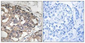 Immunohistochemical analysis of paraffin-embedded human breast carcinoma tissue using Anti-B-RAF Antibody. The right hand panel represents a negative control, where the antibody was pre-incubated with the immunising peptide.