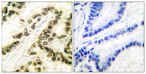 Immunohistochemical analysis of paraffin-embedded human lung carcinoma tissue using Anti-AP-2 Antibody. The right hand panel represents a negative control, where the antibody was pre-incubated with the immunising peptide