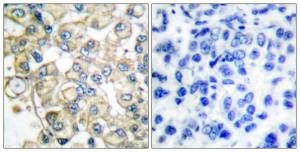 Immunohistochemical analysis of paraffin-embedded human breast carcinoma tissue using Anti-FGFR1 Oncogene Partner Antibody. The right hand panel represents a negative control, where the antibody was pre-incubated with the immunising peptide