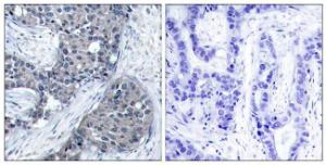 Immunohistochemical analysis of paraffin-embedded human breast carcinoma using Anti-eIF4E (phospho Ser209) Antibody. The right hand panel represents a negative control, where the antibody was pre-incubated with the immunising peptide