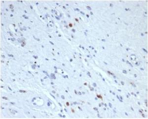 Immunohistochemical analysis of formalin-fixed, paraffin-embedded human rhabdomyosarcoma tissue using Anti-Myogenin Antibody [rMYOG/6297]