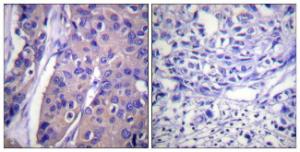 Immunohistochemical analysis of paraffin-embedded human breast carcinoma using Anti-C-RAF (phospho Ser296) Antibody. The right hand panel represents a negative control, where the Antibody was pre-incubated with the immunising peptide