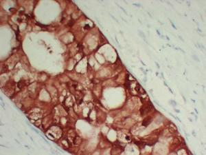 Immunohistochemical analysis of paraffin-embedded human Pancreatic adenocarcinoma-high magnification using Anti-S100A6 Antibody