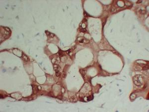 Immunohistochemical analysis of paraffin-embedded human Pancreatic adenocarcinoma-high magnification using Anti-S100A6 Antibody