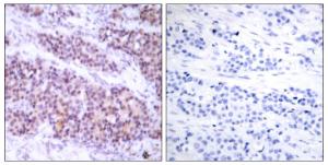 Immunohistochemical analysis of paraffin-embedded human breast carcinoma using Anti-BCL-XL (phospho Ser62) Antibody. The right hand panel represents a negative control, where the antibody was pre-incubated with the immunising peptide