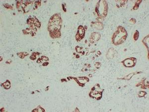 Immunohistochemical analysis of paraffin-embedded human Pancreatic adenocarcinoma using Anti-S100A6 Antibody