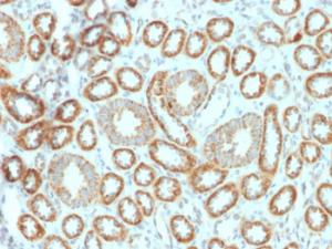 Immunohistochemical analysis of formalin-fixed, paraffin-embedded human renal cell carcinoma using Anti-EPO Antibody [EPO/1367]