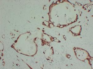 Immunohistochemical analysis of paraffin-embedded human Pancreatic adenocarcinoma using Anti-S100A6 Antibody