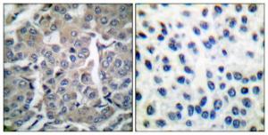 Immunohistochemical analysis of paraffin-embedded human breast carcinoma tissue using Anti-acetyl CoA Carboxylase Antibody. The right hand panel represents a negative control, where the antibody was pre-incubated with the immunising peptide