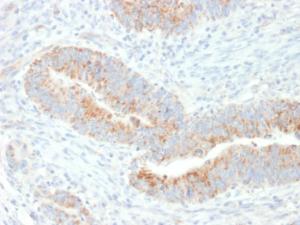 Immunohistochemical analysis of formalin-fixed, paraffin-embedded human colon carcinoma using Anti-EPO Antibody [EPO/1367]