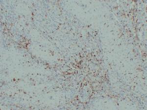 Immunohistochemical analysis of paraffin-embedded human Cutaneous squamous cell carcinoma using Anti-S100A4 Antibody