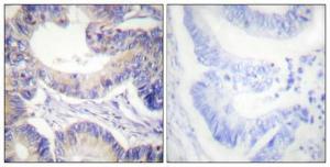 Immunohistochemical analysis of paraffin-embedded human colon cancer using Anti-acetyl CoA Carboxylase Antibody 1:100 (4 °C overnight). The right hand panel represents a negative control, where the antibody was pre-incubated with the immunising peptide