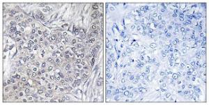 Immunohistochemical analysis of paraffin-embedded human breast carcinoma using Anti-4E-BP1 (phospho Thr45) Antibody. The right hand panel represents a negative control, where the antibody was pre-incubated with the immunising peptide.