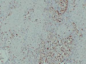 Immunohistochemical analysis of paraffin-embedded human Cutaneous squamous cell carcinoma using Anti-S100A4 Antibody