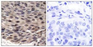 Immunohistochemical analysis of paraffin-embedded human breast carcinoma using Anti-4E-BP1 (phospho Thr36) Antibody. The right hand panel represents a negative control, where the Antibody was pre-incubated with the immunising peptide