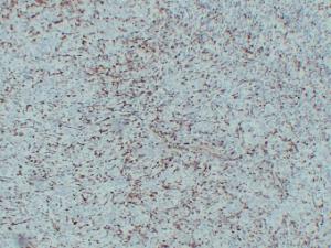 Immunohistochemical analysis of paraffin-embedded human Malignant melanoma using Anti-S100A4 Antibody