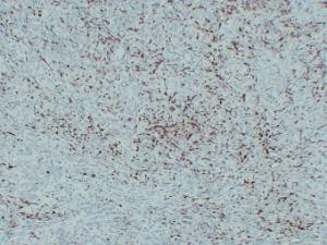 Immunohistochemical analysis of paraffin-embedded human Malignant melanoma using Anti-S100A4 Antibody